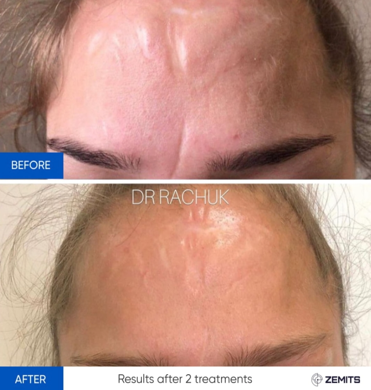 Zemits CarbonFrax Pro: CO2 Fraksiyonel Lazer