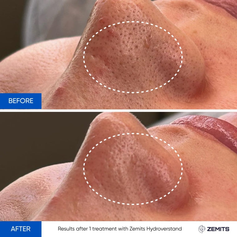 Zemits HydroVerstand PRO 7'si 1 arada HydroDiamond™ Sistemi