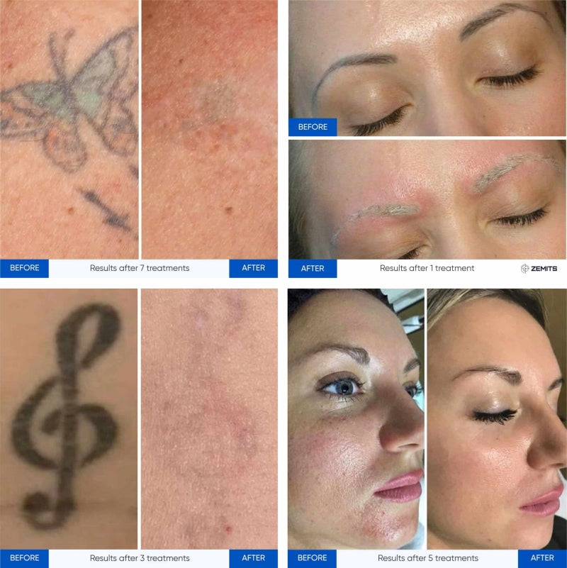 Zemits YAGenix Q-Switched Nd:YAG Lazer